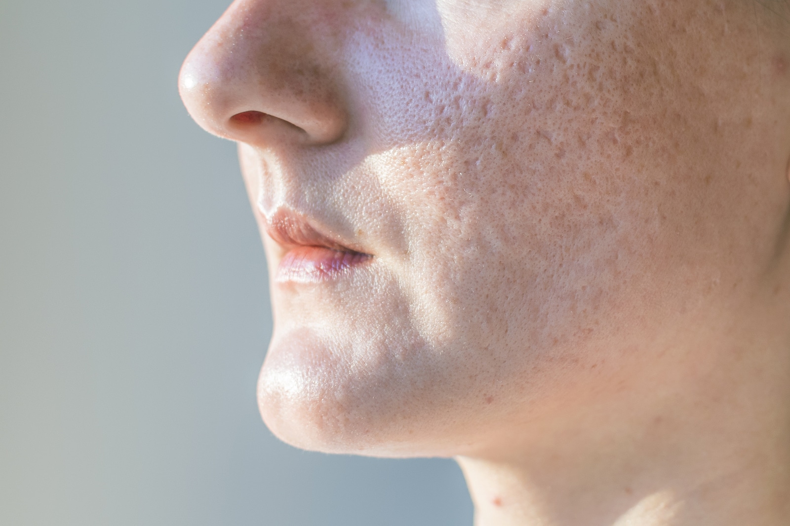 Chemical Peels for Acne Scars - Reducing Acne and Acne Scarring